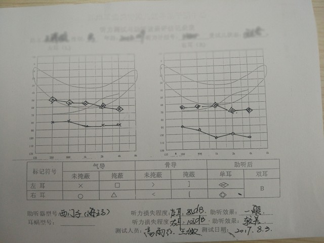 助听器